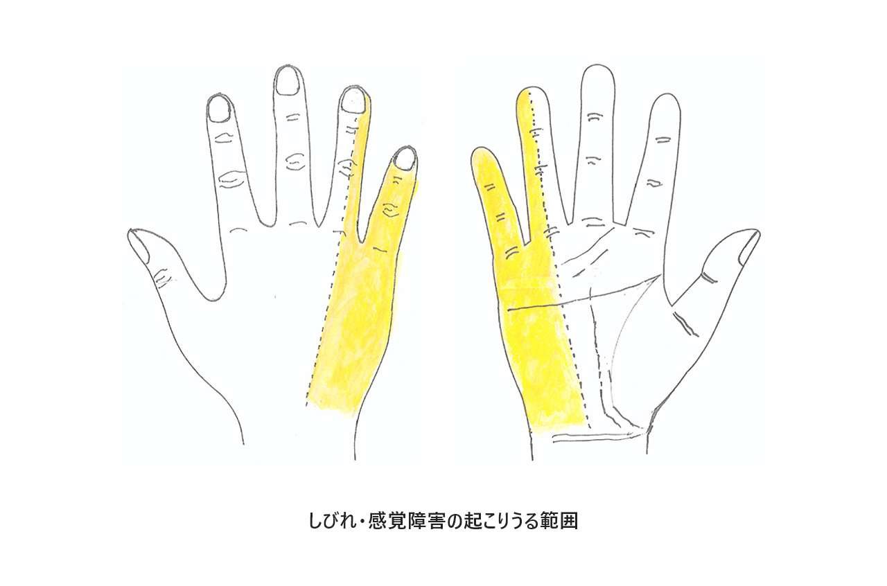 しびれ・感覚障害の起こりうる範囲